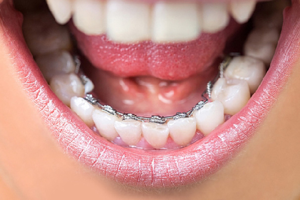 lingual braces