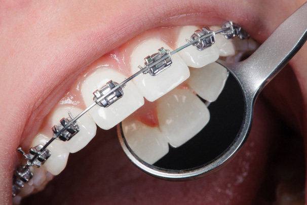 Traditional Braces