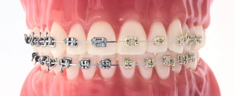 Iconix Vs Traditional Braces