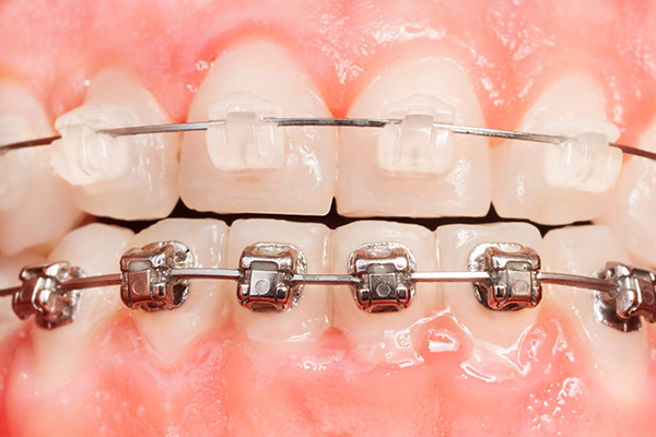 Pros And Cons Of Clear Braces Vs. Metal