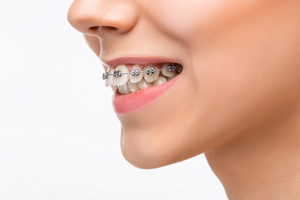 Traditional Metal Braces