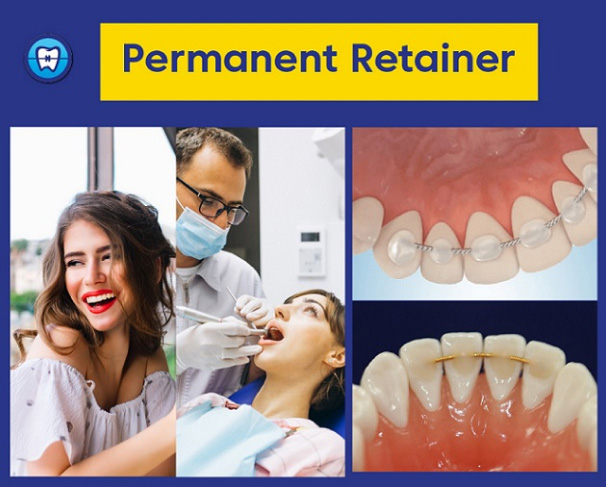 Permanent Retainer