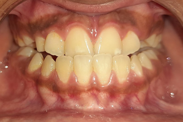 severe underbite