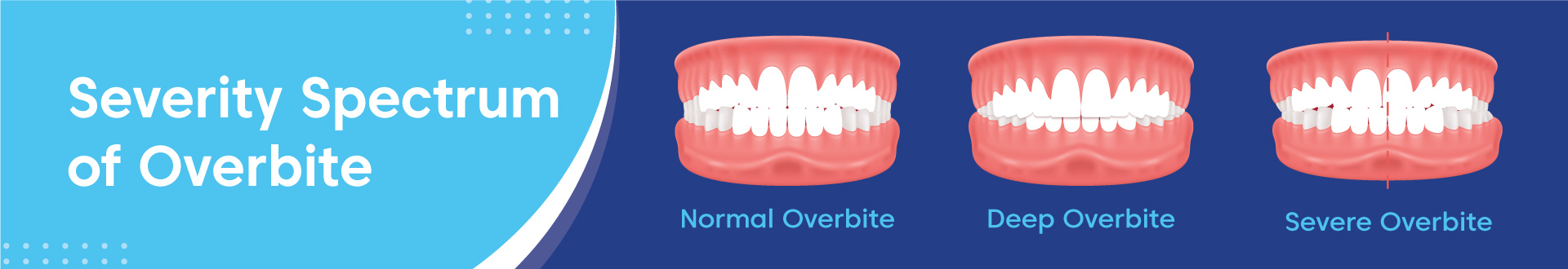 Severity Spectrum Of Overbite