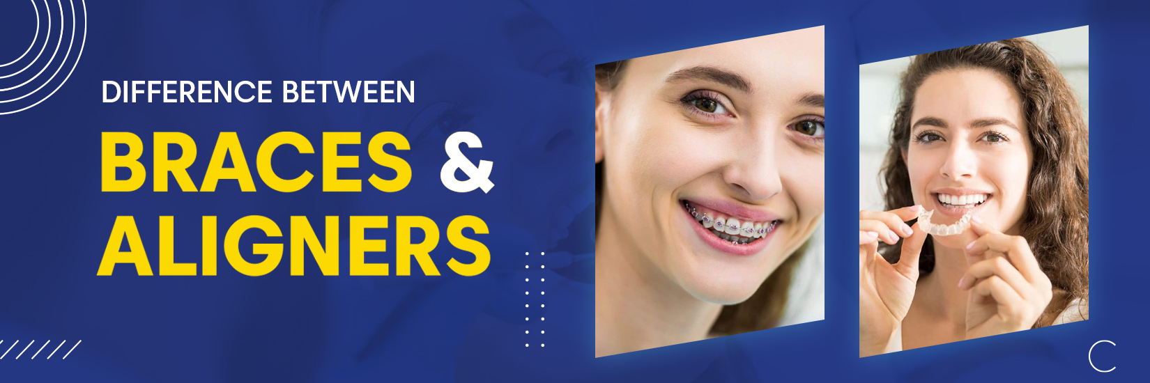 Difference Between Braces and Aligners