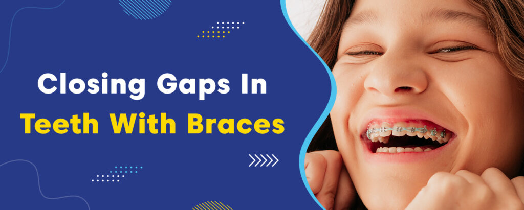 Closing Gaps In Teeth With Braces